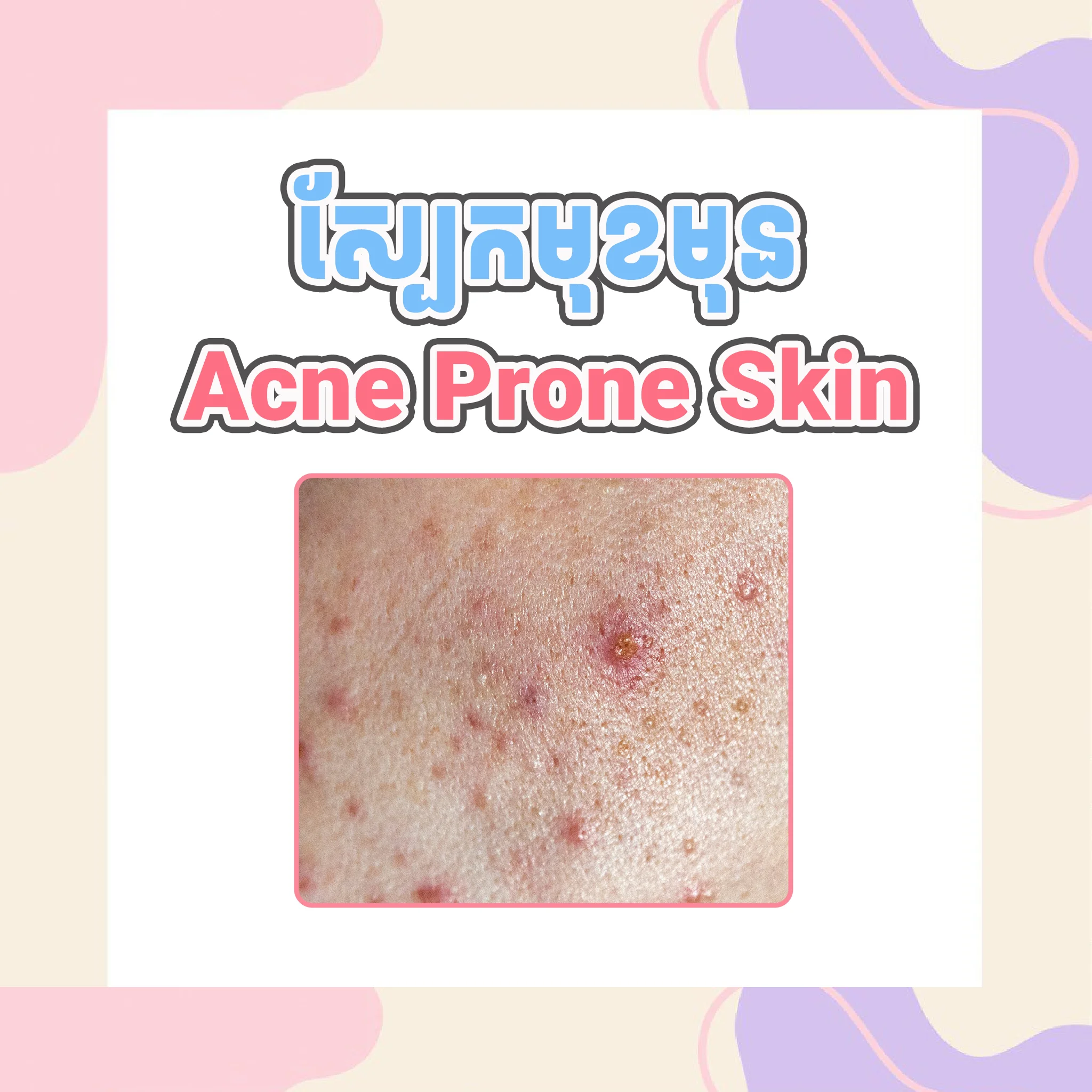 Acne Prone Skin