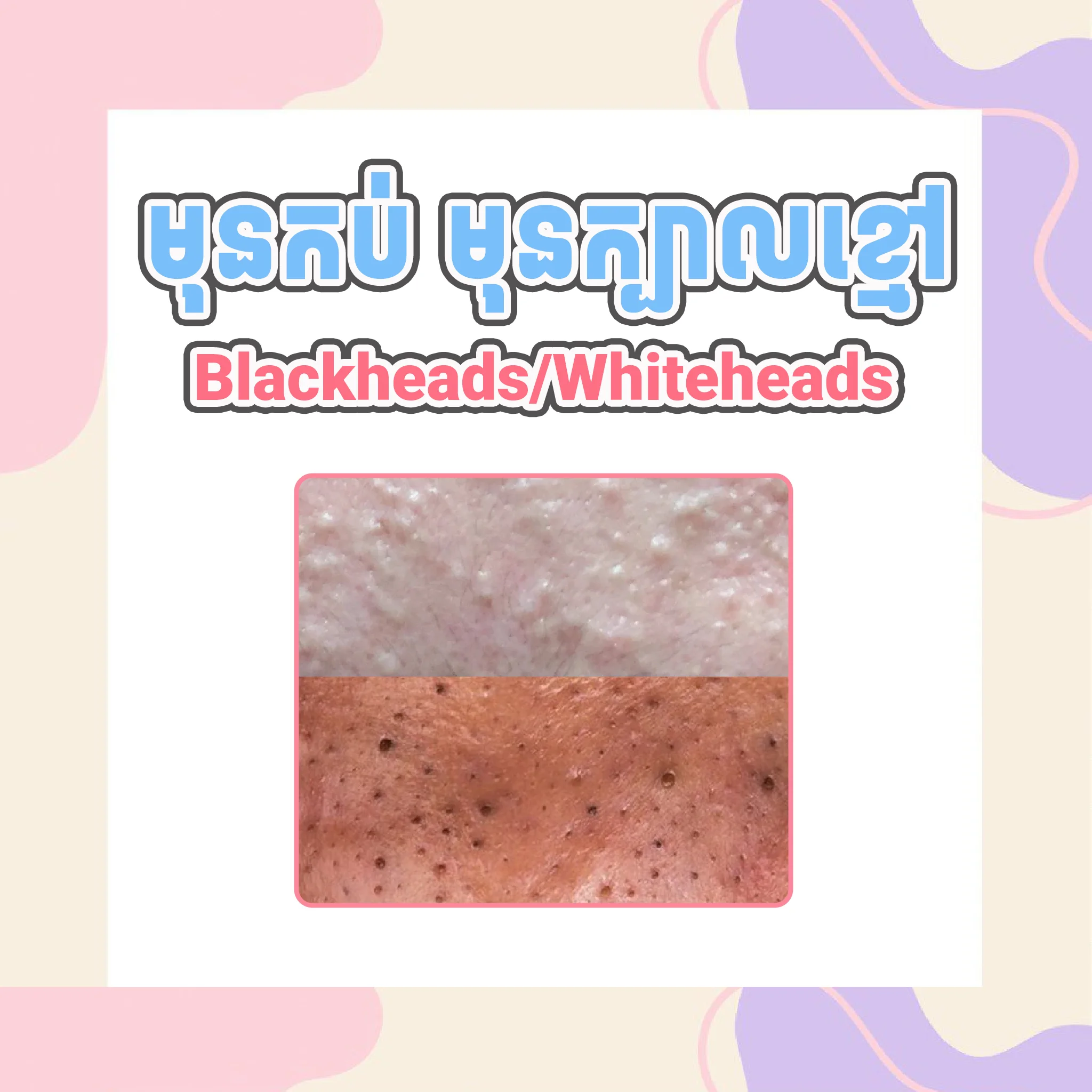 Blackheads/Whiteheads