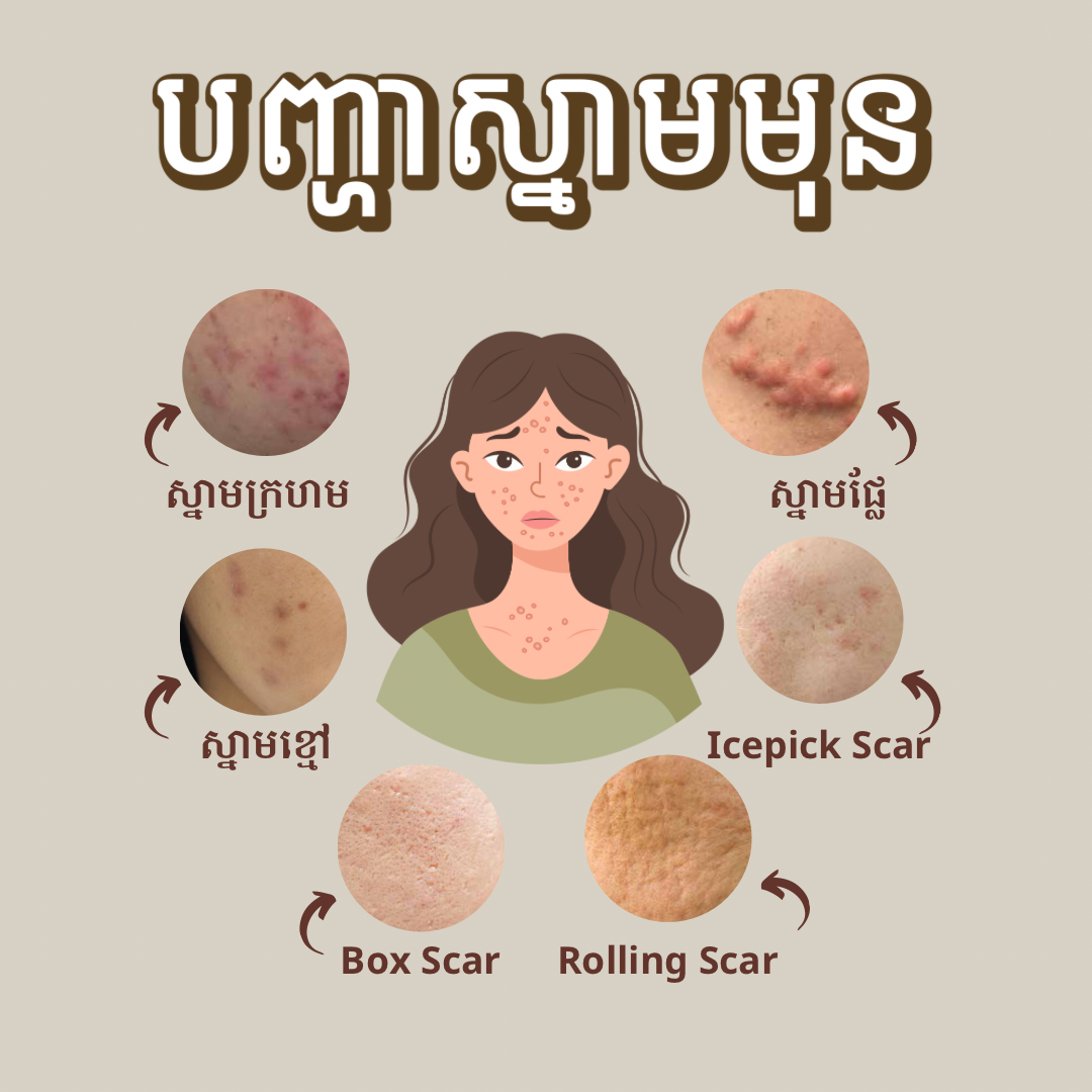 Acne Marks/Scars